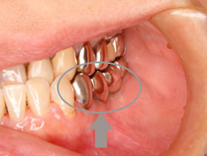 矢印で示した歯がインプラントです。