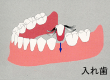 治療比較（ブリッジ・入れ歯との比較）