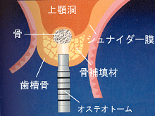 ソケットリフト