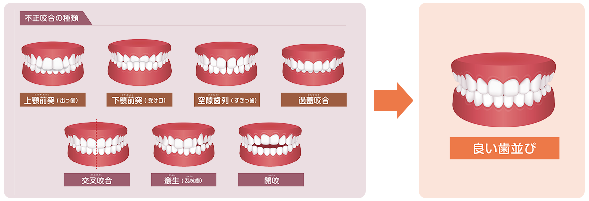 イラスト：不正咬合のイメージ