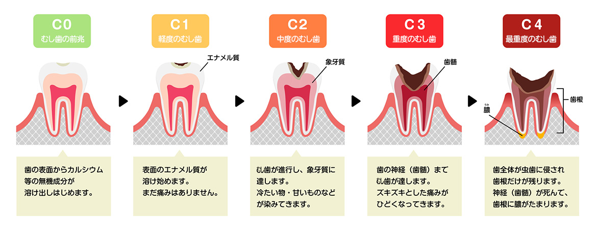 イラスト：むし歯の進行のイメージ