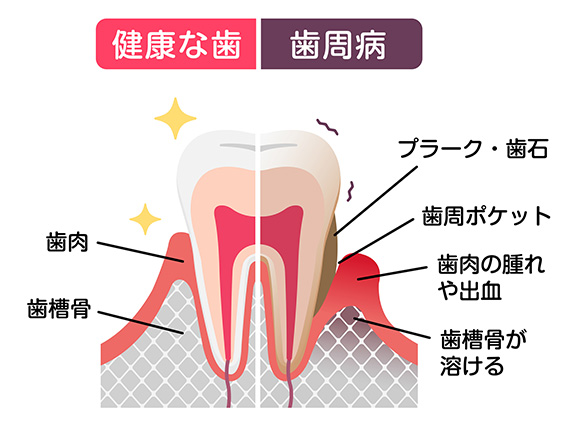 歯 周 病 症状