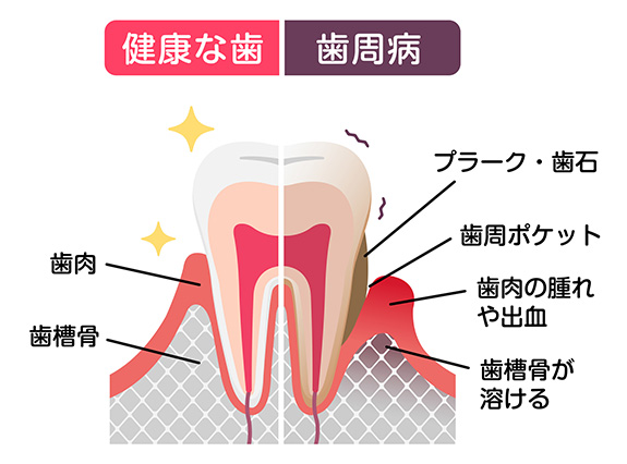 イラスト：歯周病症状のイメージ