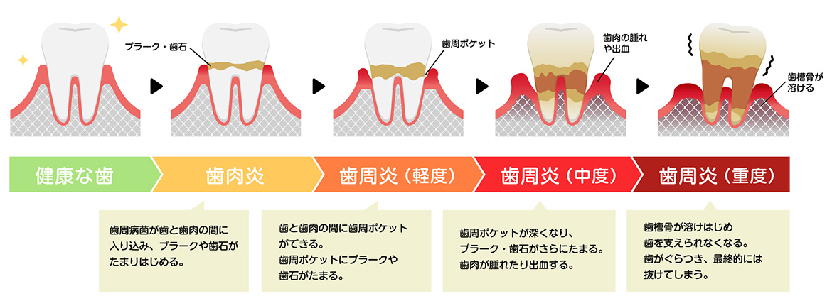 イラスト：歯周病症状のイメージ