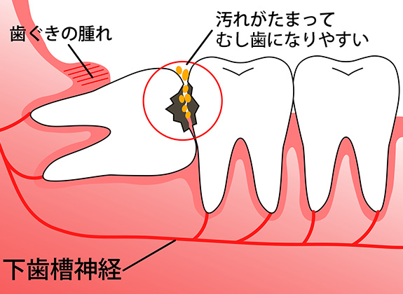 口腔外科、親知らず